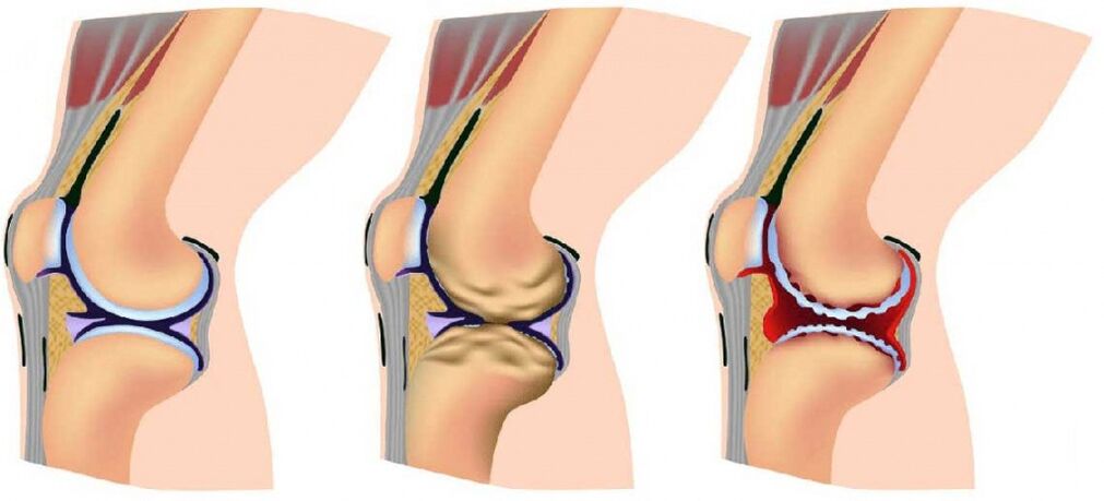 Healthy articulation and affected by arthrosis