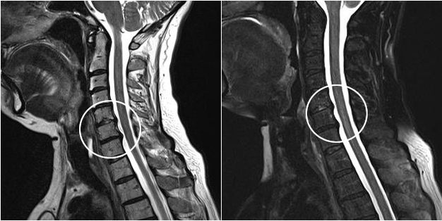 cervical osteochondrosis on magnetic resonance imaging