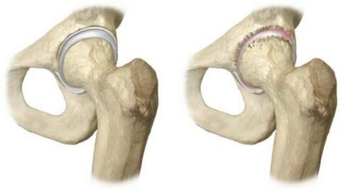healthy hip joint and affected by osteoarthritis